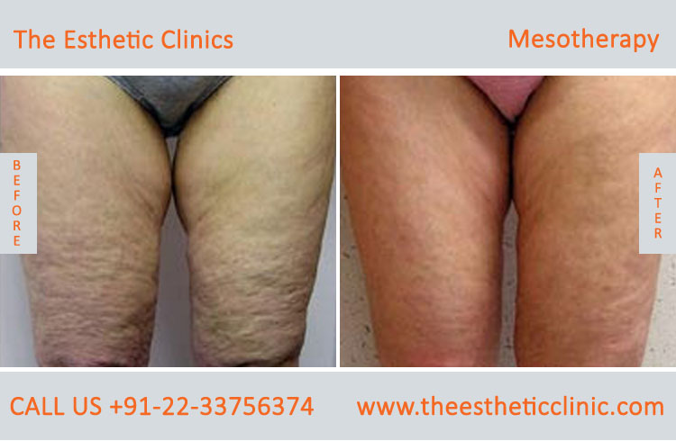 Mesotherapy for Hair Loss Face Skin Treatment before after photos in mumbai india (1)
